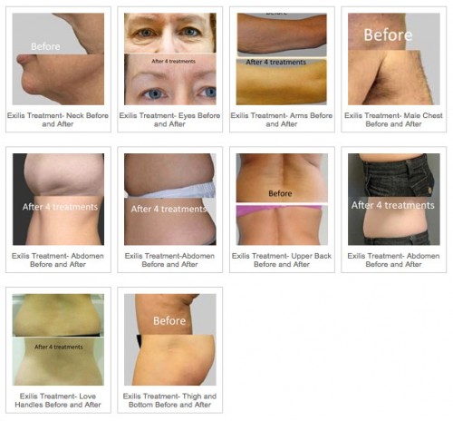 Exilis Body Shaping and Skin Tightening! - The Laser Image Company