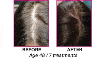 PRP for Hair Loss - Skin Essentials